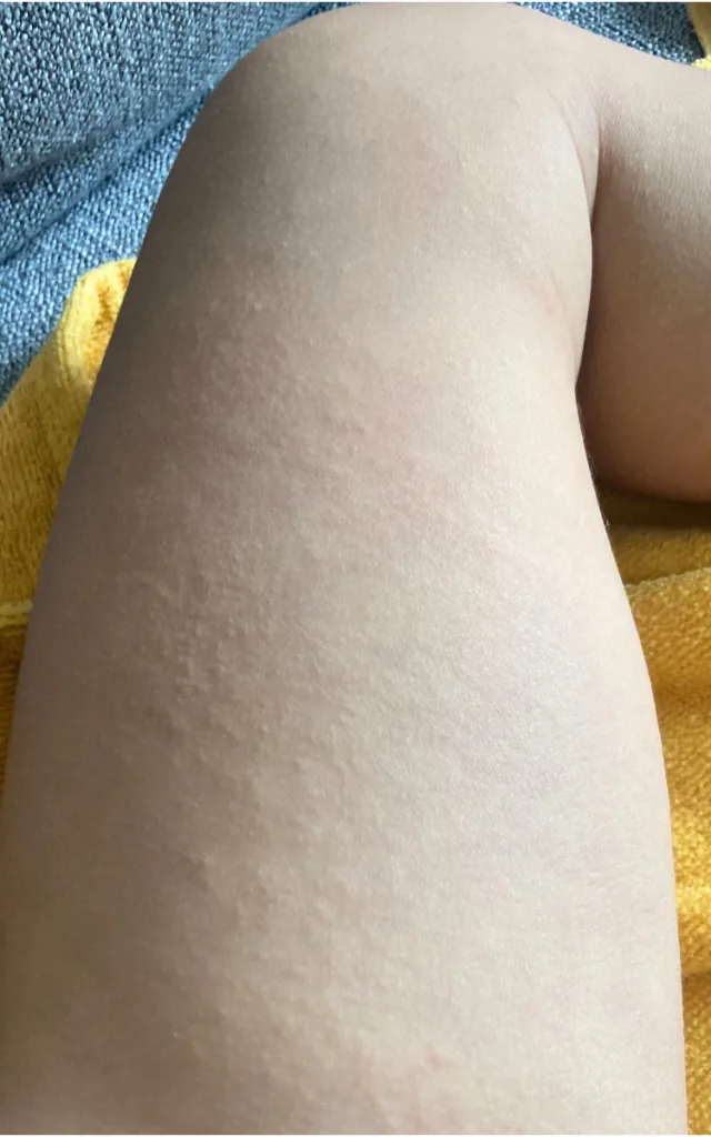 After: Eczema – 3 weeks
