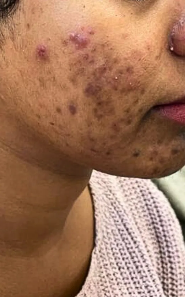 Before: Acne – 8 weeks