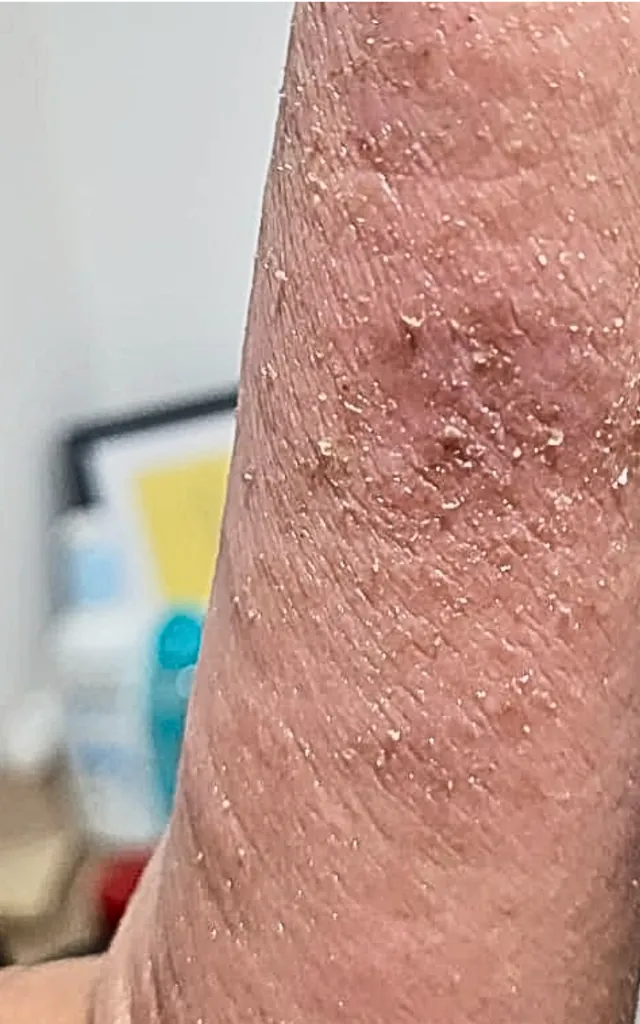 Before: Eczema – 4 weeks