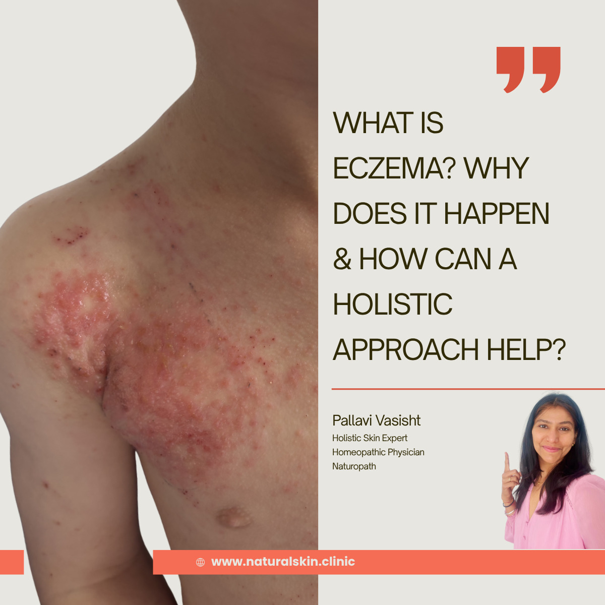 What is eczema and how a holistic approach can help